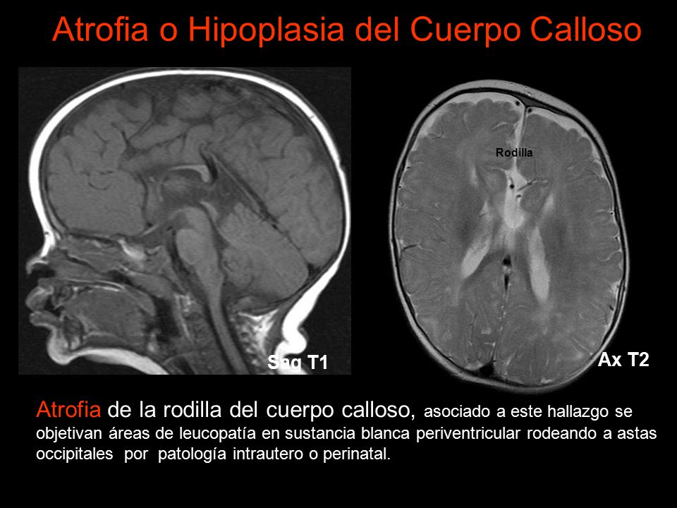 agenesia de cuerpo calloso e hidrocefalia